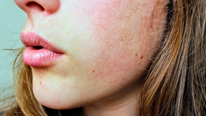 How to prevent and how to treat scrab on face – skin care