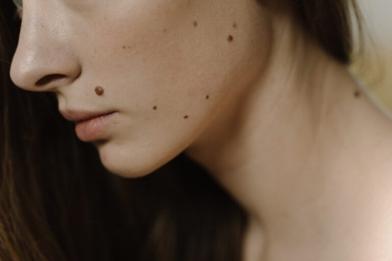 Hairy moles – find out why does hair grow out of moles - Life Style Idea